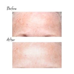 TRINITY WRINKLE REDUCER ATTACHMENT 6 TRINITY WRINKLE REDUCER ATTACHMENT -Omorovicza Shop nuface trinity wrinkle reducer forehead BA